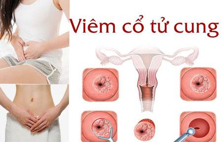 5dddf7c2bfebd81192902820_cach-dieu-tri-viem-co-tu-cung.jpg