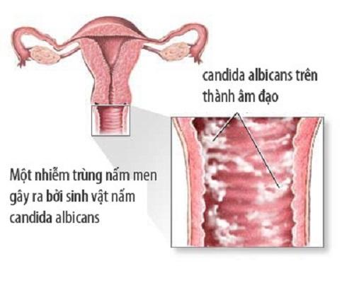 benh-nam-candida-o-phu-nu-co-tu-khoi-khong(1).jpg